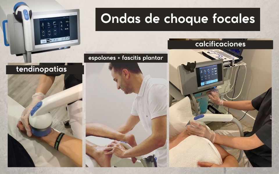 Ondas de choque focales : tecnología de vanguardia para múltiples lesiones